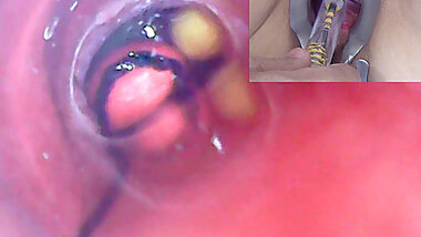 Mature Woman, Peehole Endoscope Camera in Bladder with Balls